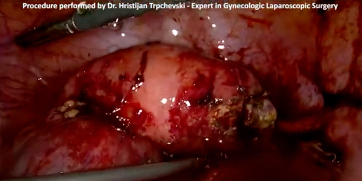 difficult-laparoscopic-adnexectomy-for-tubo-ovarian-abscess-1200x599.jpg