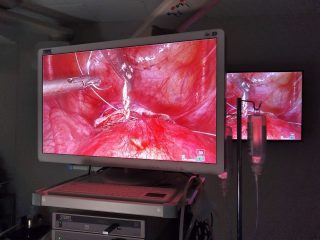 Laparoscopic Cerclage Placement