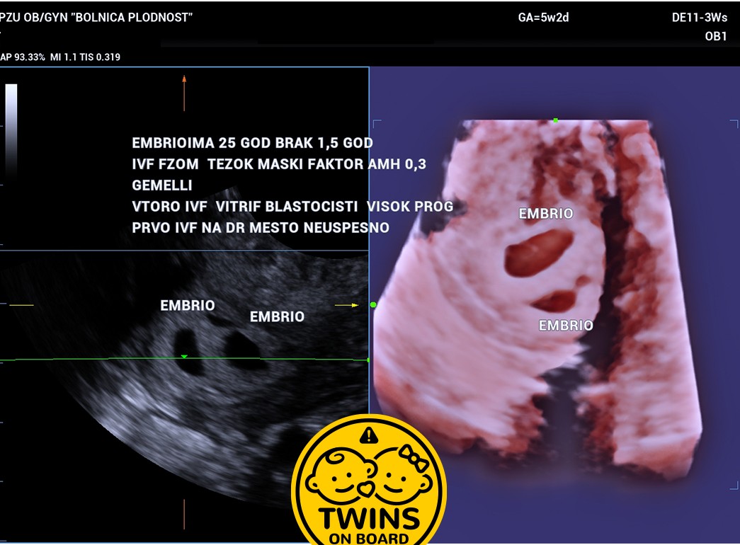Age 25 1 5 Years Married Male Factor Infertility Low Amh 0 3 2nd Ivf Twins