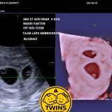 Age 27 3 Years Married Male Factor Infertility Icsi Time Lapse