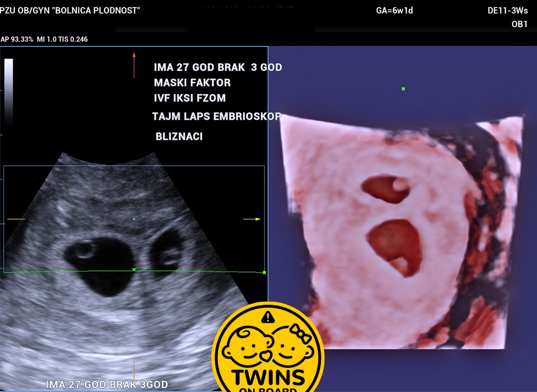 Age 27 3 Years Married Male Factor Infertility Icsi Time Lapse