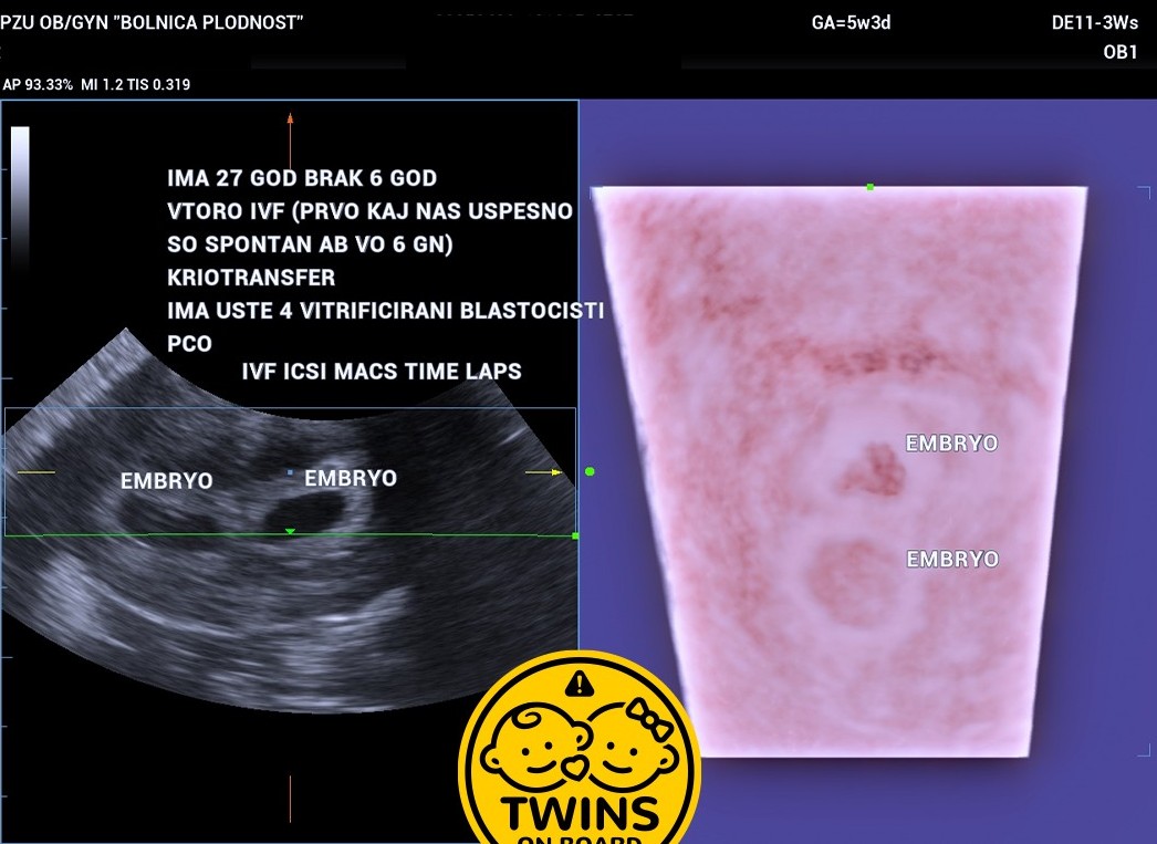 Age 27 6 Years Married Pcos 2nd Ivf Cryotransfer Twins