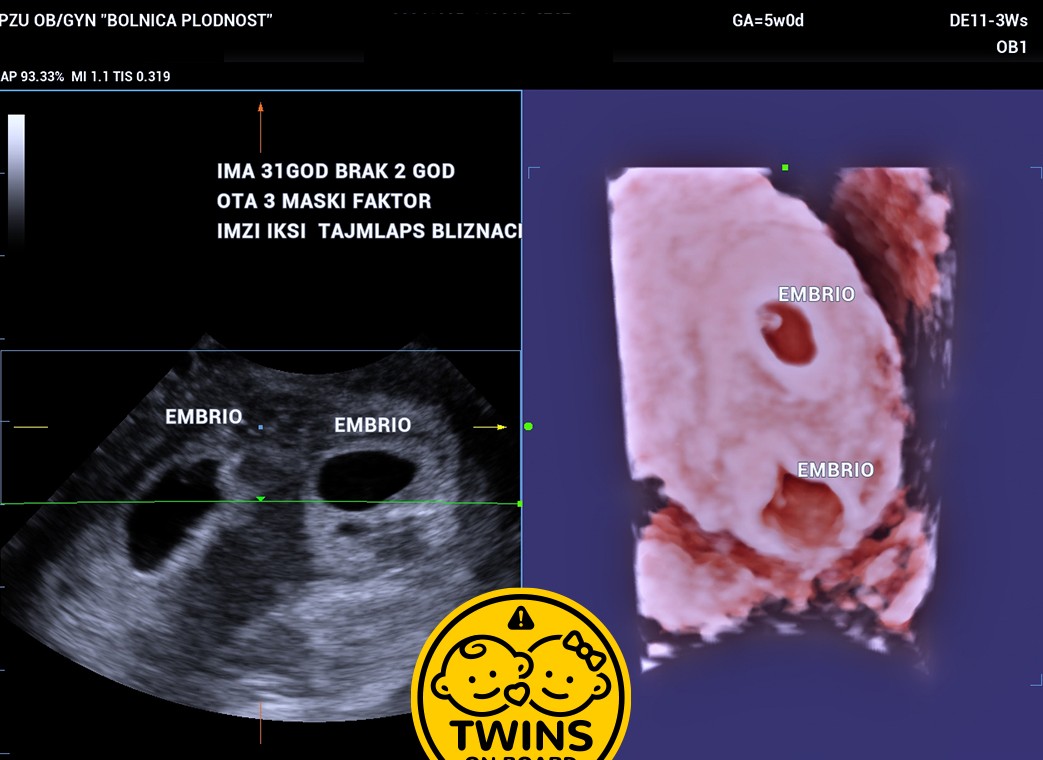 Age 31 2 Years Married Severe Male Factor Imzi Icsi Time Lapse