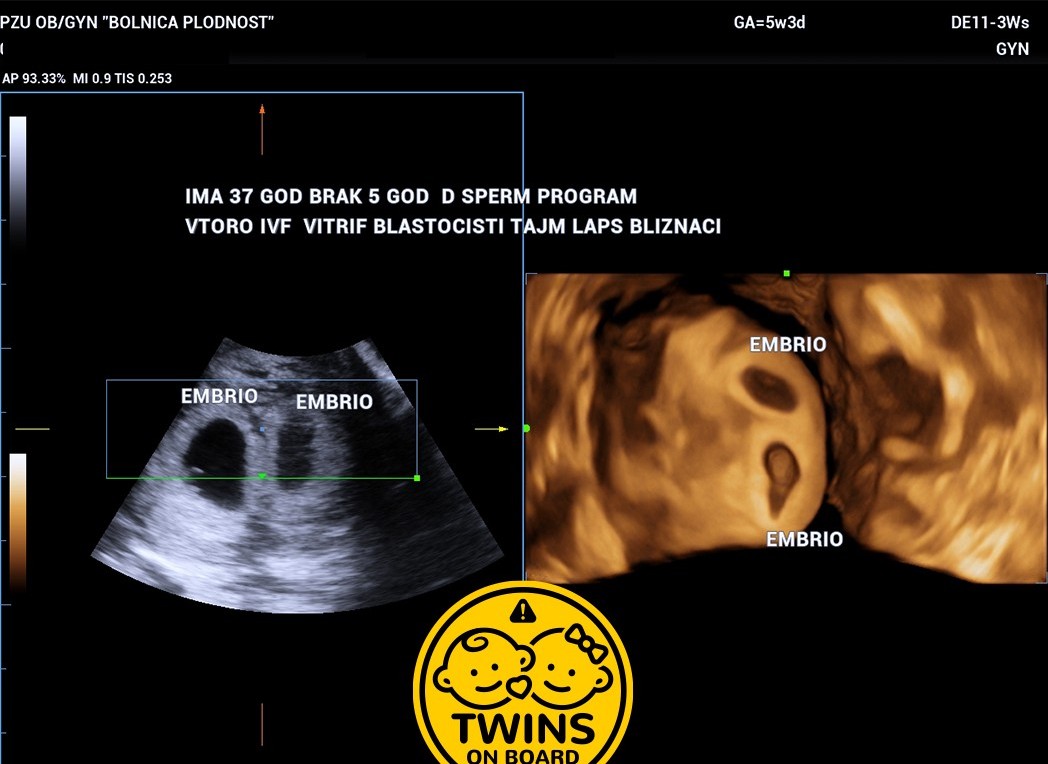 Age 37 5 Years Married Donor Sperm 2nd Ivf Time Lapse Twins
