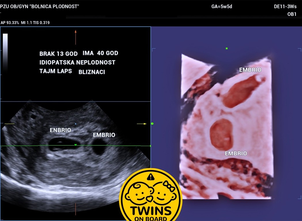 Age 40 13 Years Married Idiopathic Infertility Time Lapse Twins