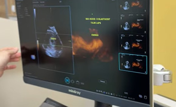 ivf-tirana-patient-success-plodnost-hospital-tashe.jpg