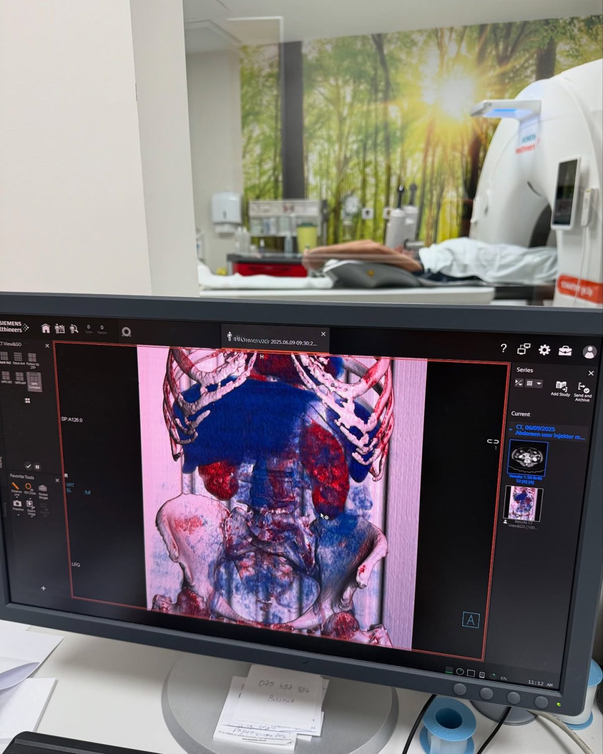 Ct Scans Plodnost Somatom