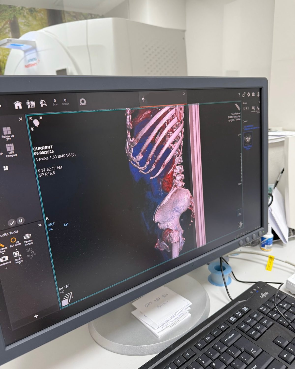 Ct Scans Plodnost Somatom Simens Go Up Results