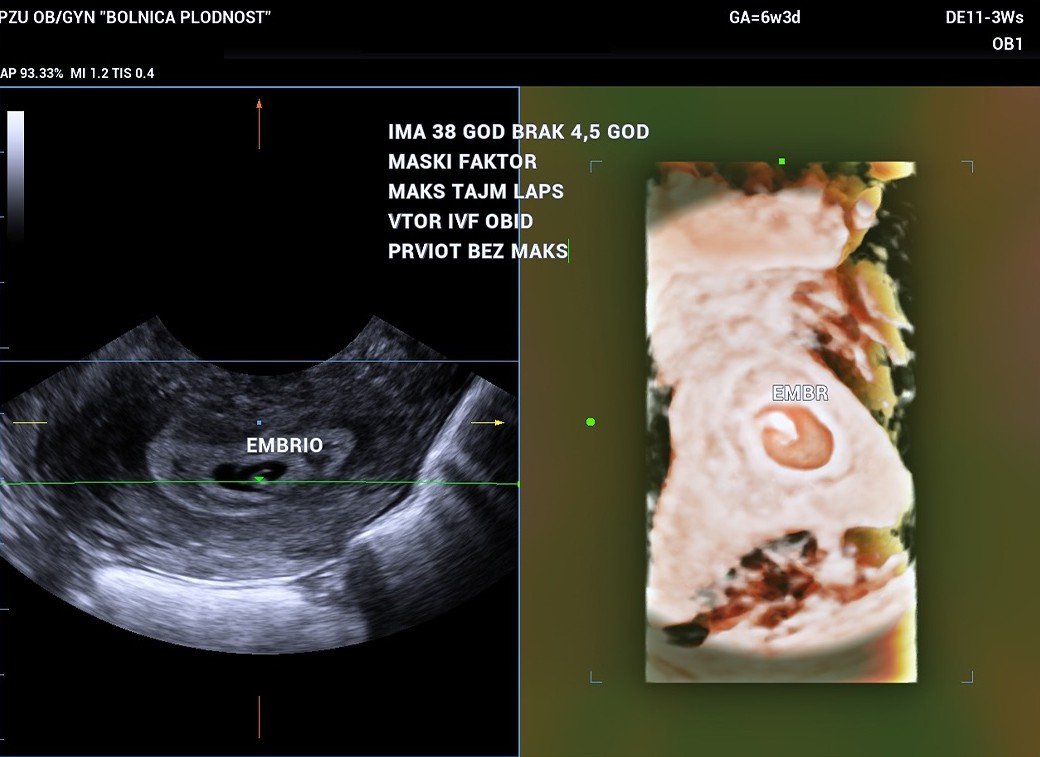 Ivf Success Story Pacient 2 Ivf Success Story Pacient 2