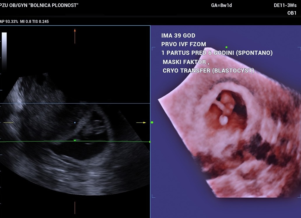 Ivf Sucess Story Pacient 1 Ivf Sucess Story Pacient 1