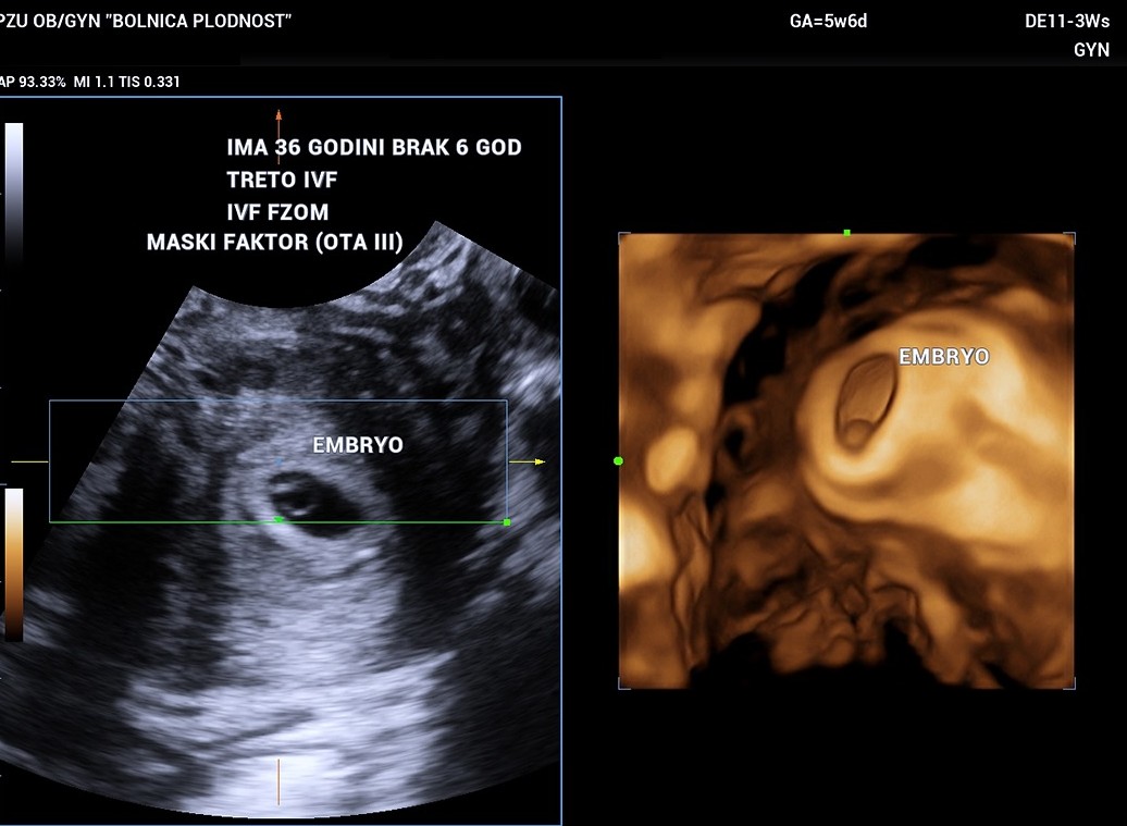 Ivf Sucess Story Pacient 3 Ivf Sucess Story Pacient 3