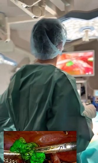 Sentinel Lymphadenectomy