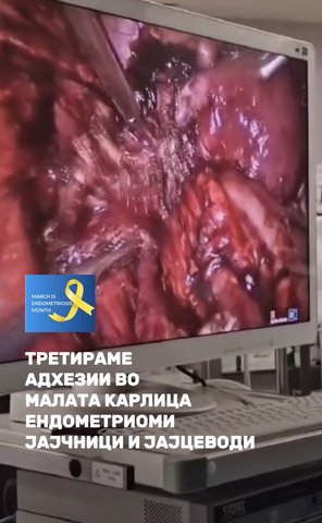 Endometriosis and infertility – laparoscopic treatment | Plodnost Bitola