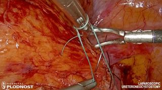 Laparoscopic Ureteroneocystostomy 00