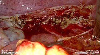 Laparoscopic Ureteroneocystostomy 01