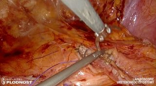 Laparoscopic Ureteroneocystostomy 02 Laparoscopic Ureteroneocystostomy 02