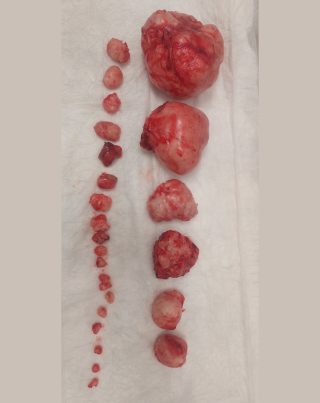Fertility Preservation In A Young Patient Through Advanced Laparoscopic Treatment Of Fibroids Miomi